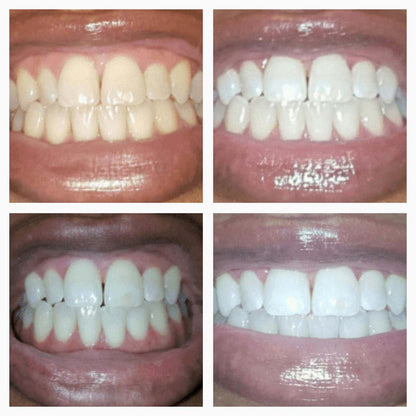 Extra-Strength Teeth Whitening Serum